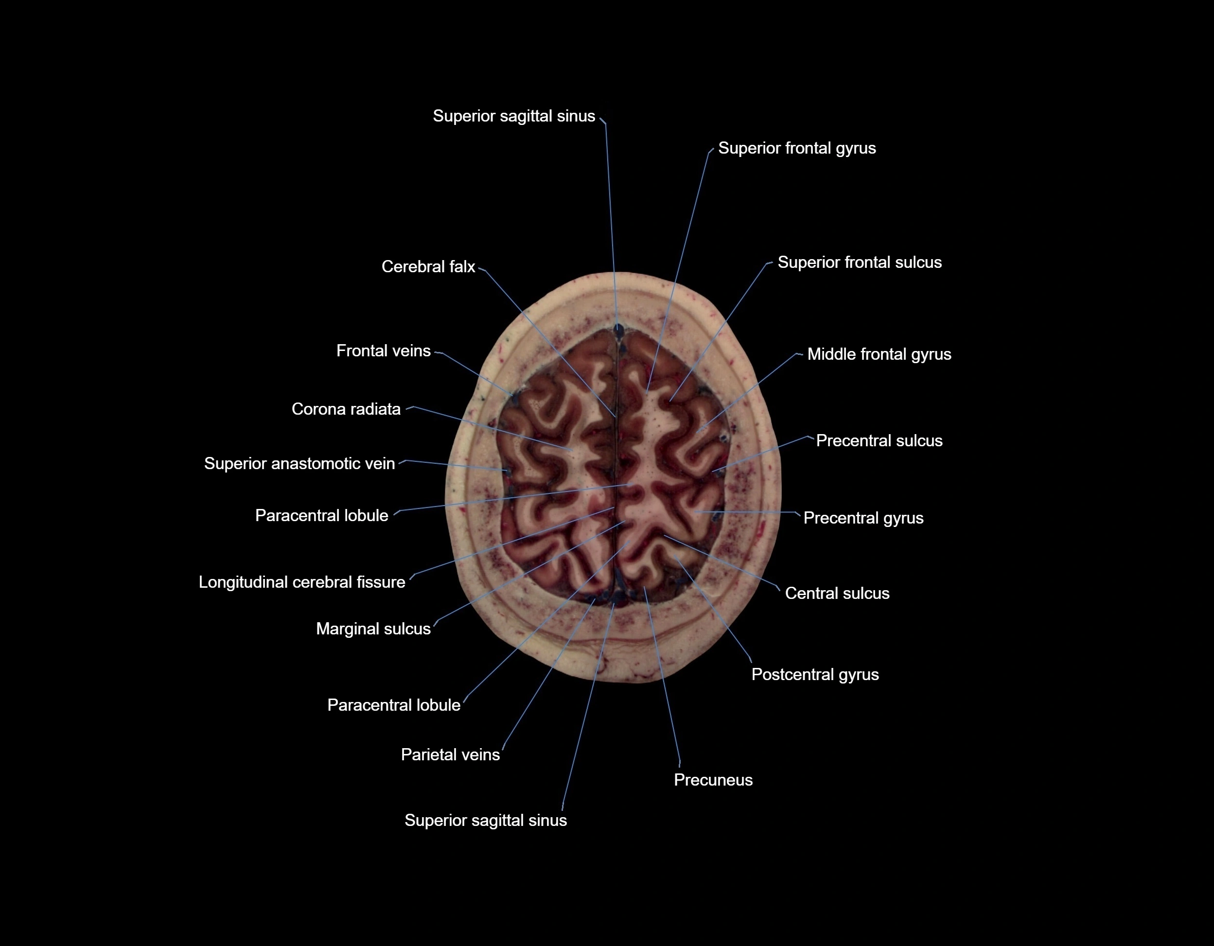 MRI Brain axial cross sectional radiology anatomy 3T image  -img-000068.webp